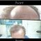 Traitements de la chute des cheveux