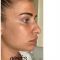 Rhinoplastie médicale