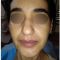 Lifting du visage
