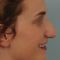 Rhinoplastie Ultrasonique