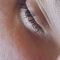 Injections d