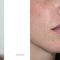 Injections d