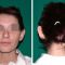 Otoplastie (Chirurgie esthétique des oreilles)