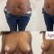 Abdominoplastie