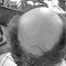 Greffe de cheveux