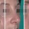Rhinoplastie