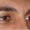 Blépharoplastie