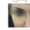 Injections d