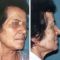 Lifting du visage