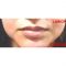 Augmentation des lèvres (acide hyaluronique)