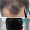 Greffe de cheveux