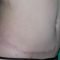 Abdominoplastie