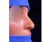 Rhinoplastie