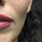 Augmentation des lèvres (acide hyaluronique)