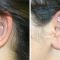 Otoplastie (Chirurgie esthétique des oreilles)