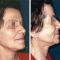 Lifting du visage