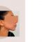 Lifting du visage