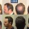 Greffe de cheveux