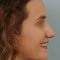 Rhinoplastie Ultrasonique