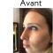 Rhinoplastie médicale
