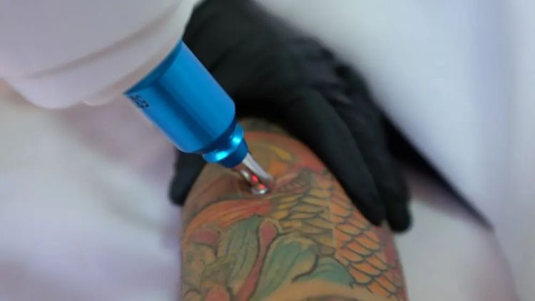 "En cabinet médical 2 technologies laser nous permettent d’éliminer les tatouages"