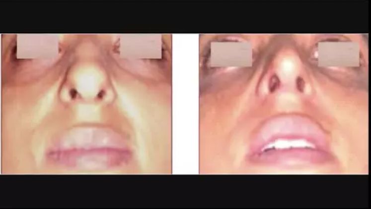 Rhinoplastie Maroc - Chirurgie esthétique et médecine esthétique du nez. Clinique IRAQI d'esthétique