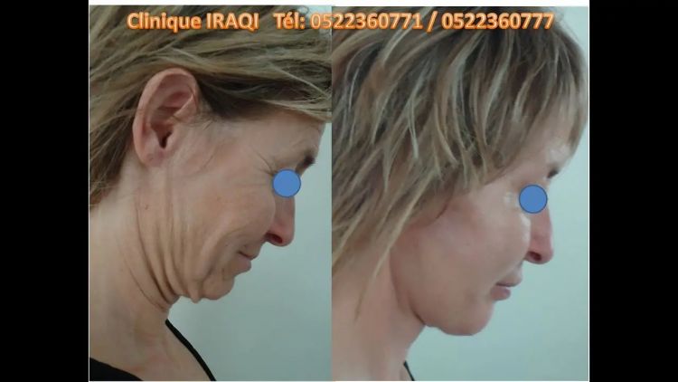 Esthétique du visage Maroc: Lifting - Botox - Filler - HIFU - Lipofilling