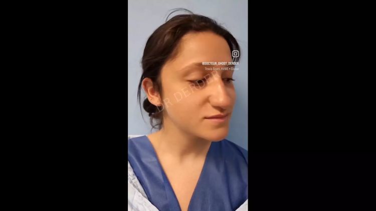 Résultat Rhinoplastie - Dr Mohamed Derder