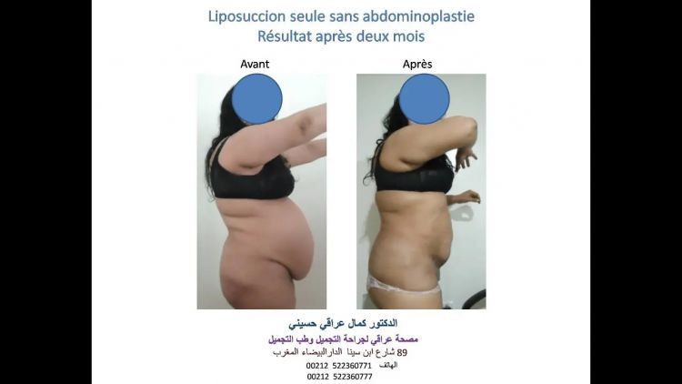 Lipoaspiration Maroc - Liposculpture Maroc Casablanca