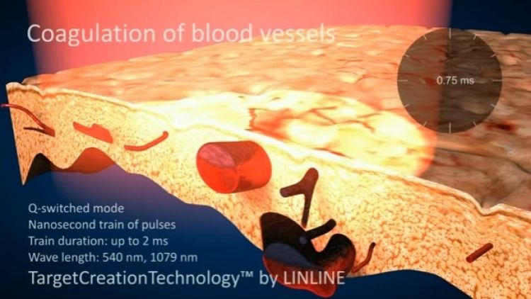 Blood vessels coagulation using the LINLINE™ method