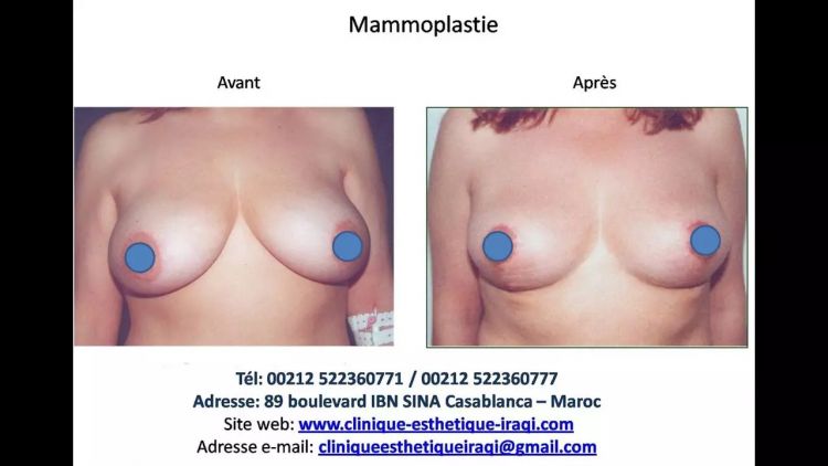 Mammoplastie Maroc - Mammoplasty Morroco - Clinique esthétique IRAQI