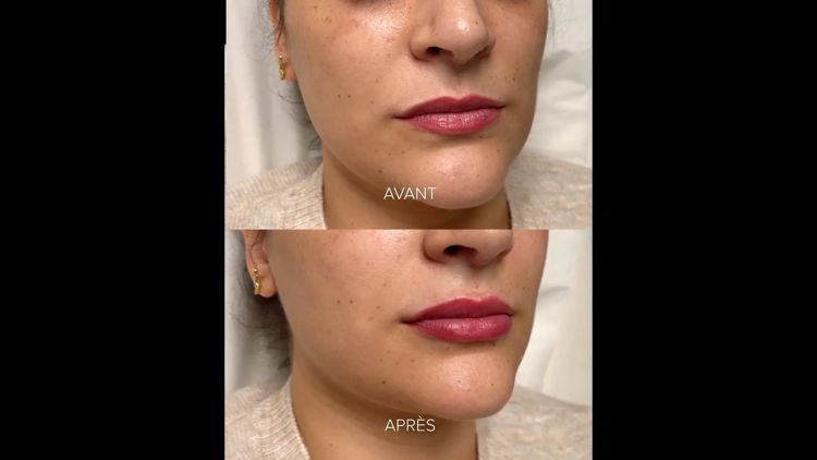 Augmentation des lèvres - Dr Alexandre Mertens
